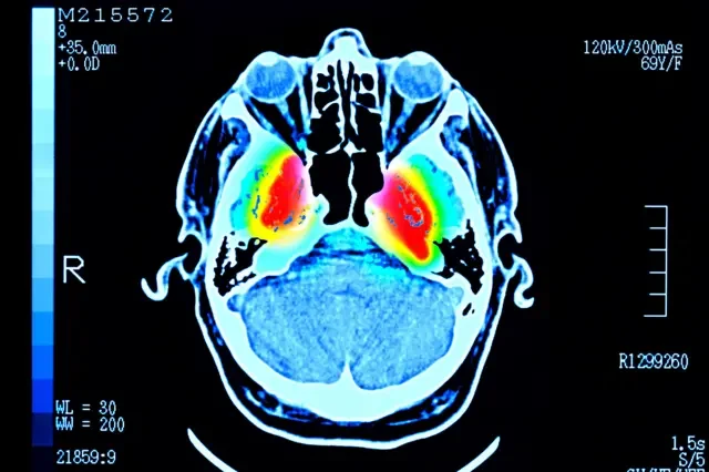 Imagem de um exame cerebral mostrando áreas vermelhas no centro, cercadas por regiões em amarelo, verde e azul-claro.